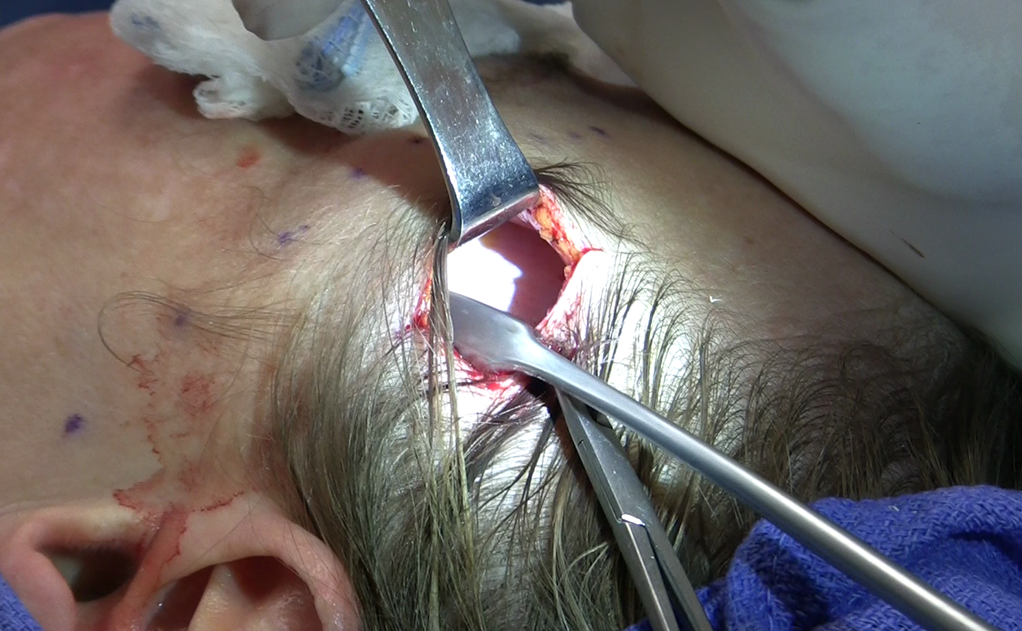 Mid_facelift_(rhytidectomy)_upper_incision